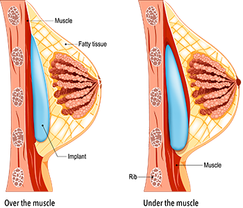 diagram of breast implant placement