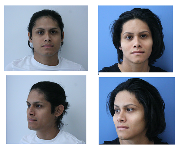 before & after of facial feminization surgery
