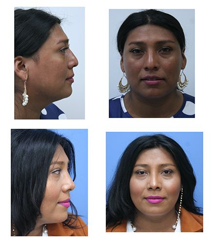 before & after of facial feminization surgery