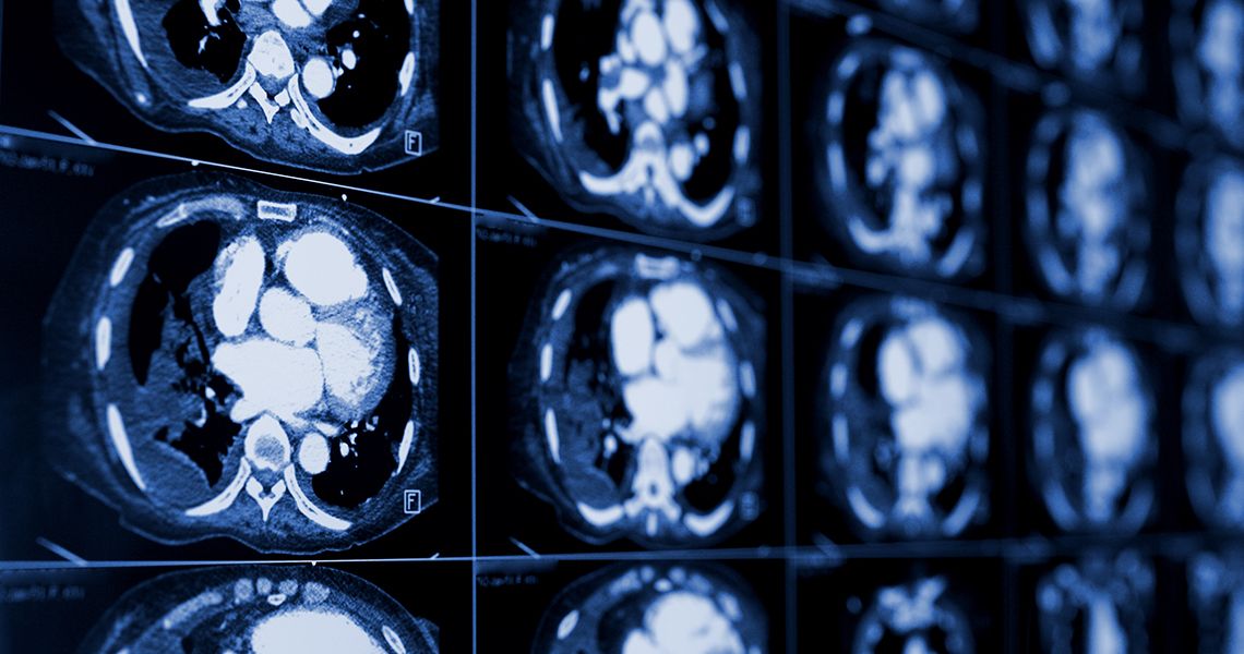Kidney CT Scan